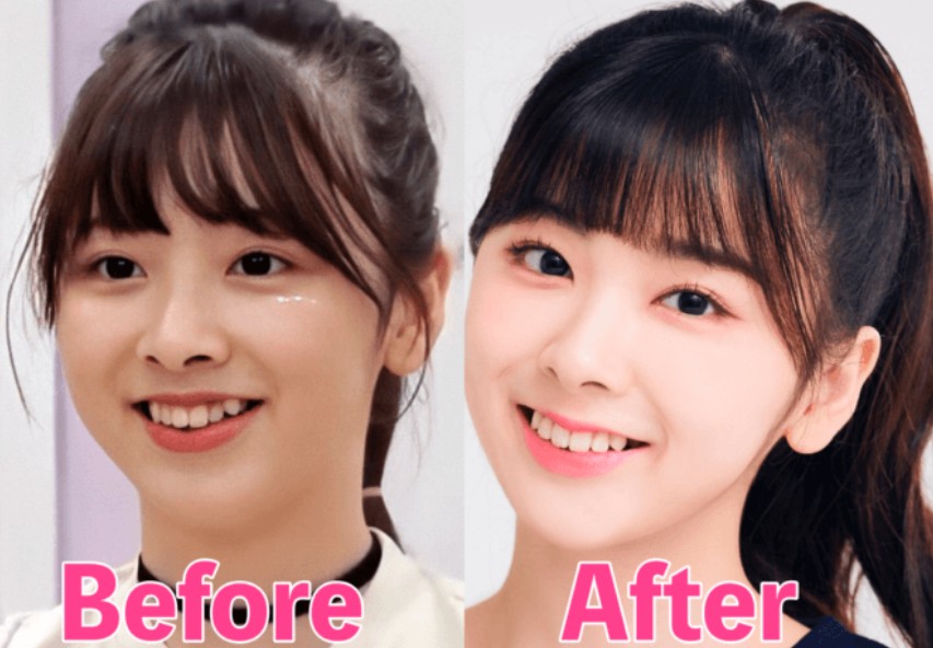 덧니 교정 전후 비교 사진 / Before and after comparison showing crooked teeth correction results