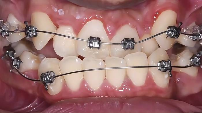 덧니 교정을 위해 교정기를 장착한 치아 모습 / Braces applied to correct crooked teeth during orthodontic treatment