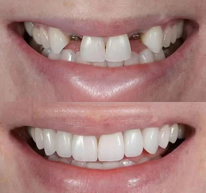 임플란트 시술 전후 치아 변화 비교 이미지 / Before and after comparison showing dental implant treatment and restored smile