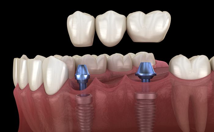 임플란트 브릿지 시술 구조를 설명하는 3D 이미지 / 3D illustration showing dental implant bridge placement and abutments