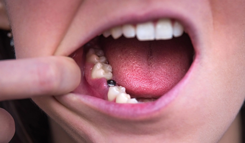 손가락으로 입 안쪽 잇몸을 가리키며 임플란트 기둥이 노출된 상태를 보여주는 장면으로, 보철물이 연결되기 전의 치유 과정이 나타나 있다. 잇몸 조직이 안정적으로 아물고 있는 시기를 시각적으로 표현한 구강 사진이다. (A person pointing inside their mouth showing an exposed dental implant post during the gum healing phase, illustrating the stage before the crown attachment in the implant recovery process.)