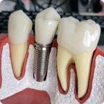 임플란트 구조를 보여주는 치아 단면 모형 / Cross-sectional dental model showing implant structure and artificial tooth root