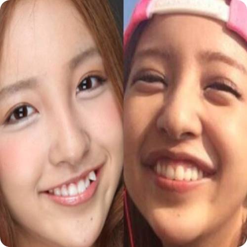 덧니가 있는 여성의 자연스러운 미소 모습 / Close-up smile of a woman with crooked teeth before orthodontic treatment