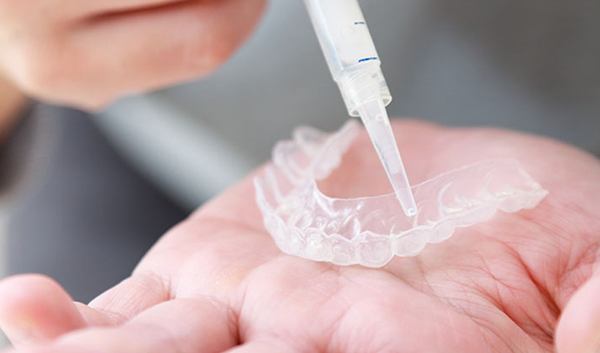 가정용 치아 미백 트레이에 미백제를 도포하는 장면 / Applying whitening gel to a home teeth whitening tray for personal use