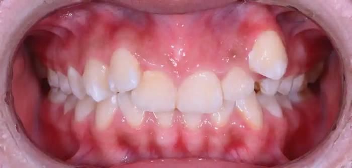 심한 덧니 배열이 보이는 치아 상태 이미지 / Image showing severe crooked teeth alignment before correction