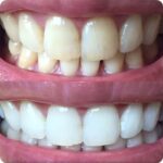 치아 미백 전후 비교 이미지 / Before and after comparison of teeth whitening results showing improved tooth color